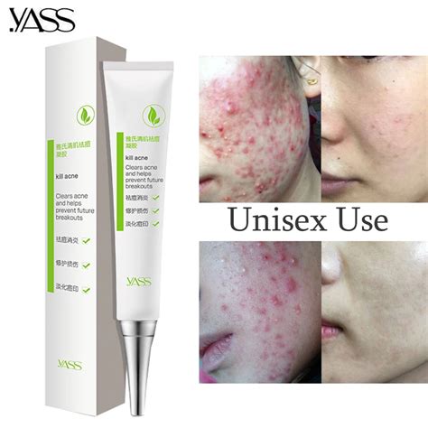 Aliexpress.com : Buy Herbal Acne Cream Anti Pimple Spot Acne Scars ...