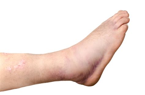 Broken Ankle | Foot Doctor | Marietta And Atlanta Area| Read More!