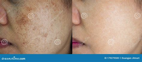 Before And After Spot Melasma Treatment Stock Photography ...