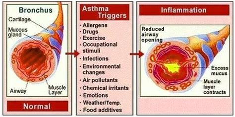 asthma triggers | Anatomy System - Human Body Anatomy diagram and chart ...