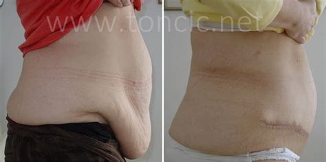 Panniculectomy vs tummy tuck - apopayment