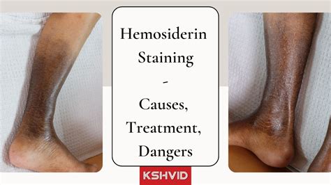 Hemosiderin Staining: Causes, Treatment, & Potential Dangers