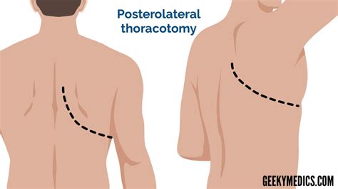 Cardiothoracic Incisions | Scars | Sternotomy | Thoracotomy | Geeky Medics