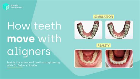 How aligners move teeth: The science behind it