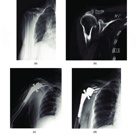 Total shoulder arthroplasty surgery. (A) Preoperative AP plain ...