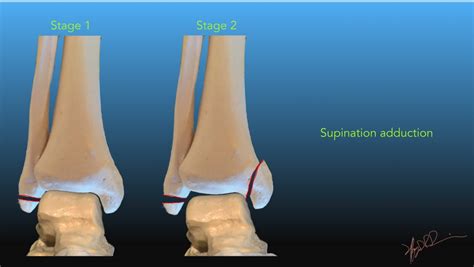 Lauge Hansen Classification of Ankle Fractures | UW Emergency Radiology