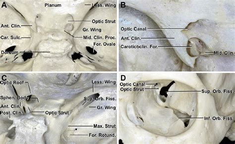 Anterior Clinoidectomy and Optic Nerve Decompression | The ...