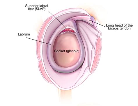 My Shoulder Superior Labrum is Torn: Do I Need Surgery? - Shoulder & Elbow