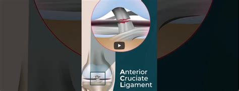 What is an ACL TEAR? - Dr Bernard Lee - Shoulder | Elbow Orthopaedic Group