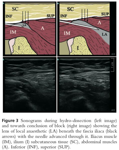 Ultrasound-guided supra-inguinal fascia iliaca block: a cadaveric ...