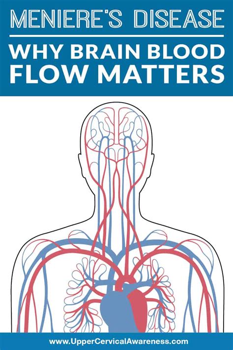 Meniere's Disease: Why Brain Blood Flow Matters - Upper Cervical Awareness