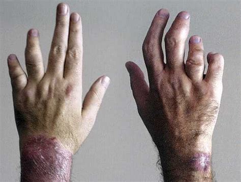 Psoriatic Arthritis: The Signs, Symptoms and Types
