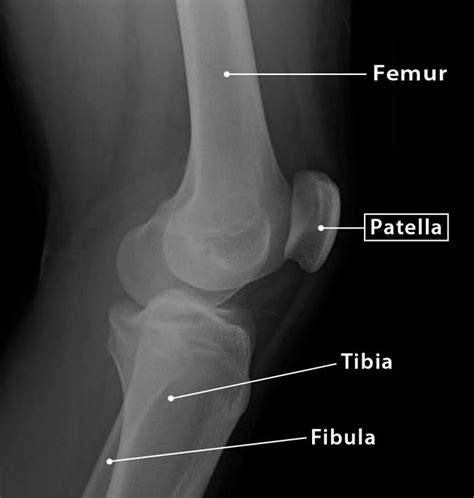 Patella (Kneecap): Definition, Location, Anatomy, & Diagram