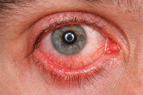 "Conjuntivitis: ¿qué es y cuál es su tratamiento? | Miranza"