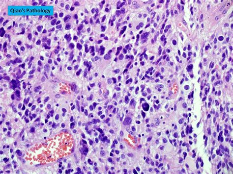 Qiao's Pathology: Glioblastoma Multiforme (GBM) (乔氏病理学：多形性… | Flickr