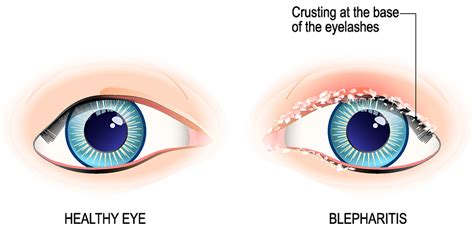 Blepharitis | AOA