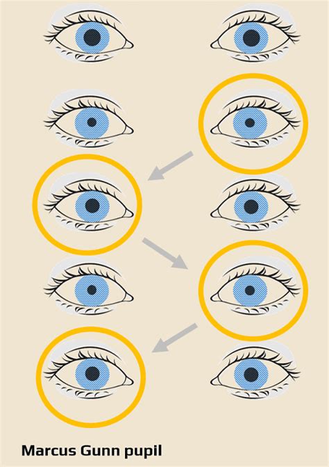 Relative afferent pupillary defect (RAPD) | STROKE MANUAL