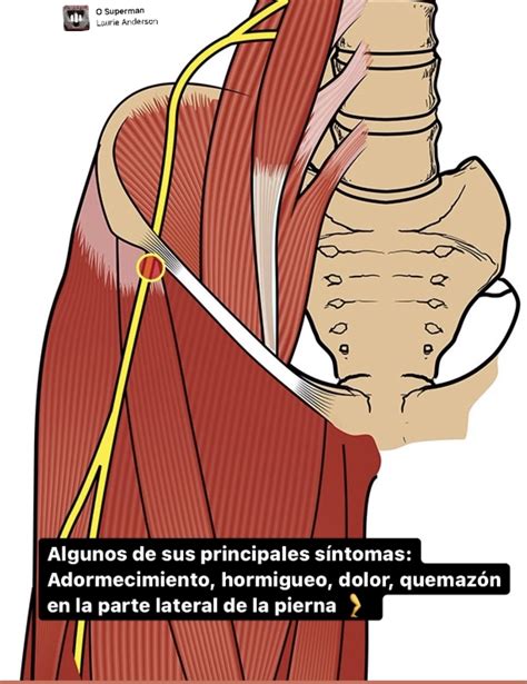 Meralgia Parestésica/Meralgia Paresthetica – drharoldsilva