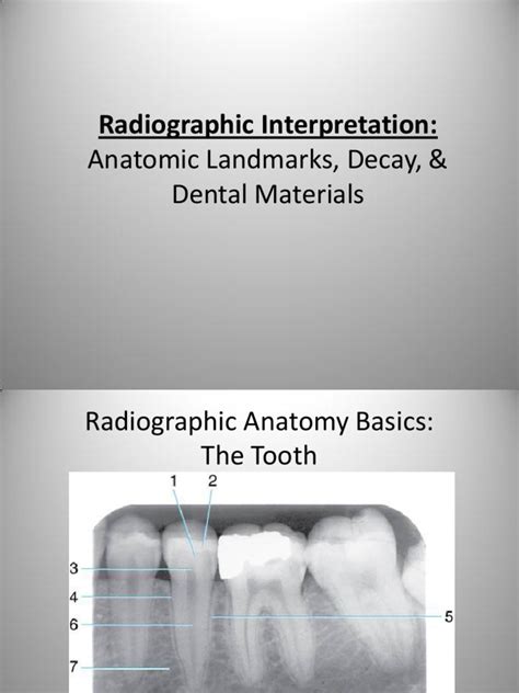 Radiographic Interpretation PPOINT | Dentistry | Mouth