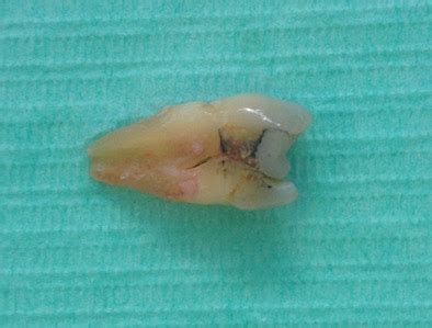 Cracked Tooth Root Photos From My Dental Practice