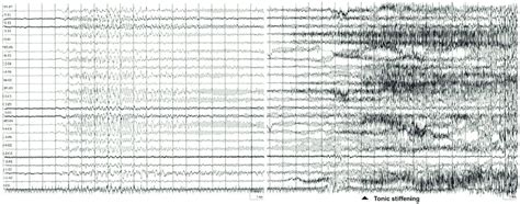 Epilepsy with isolated generalized tonic-clonic seizures: ictal EEG [24]. | Download Scientific ...