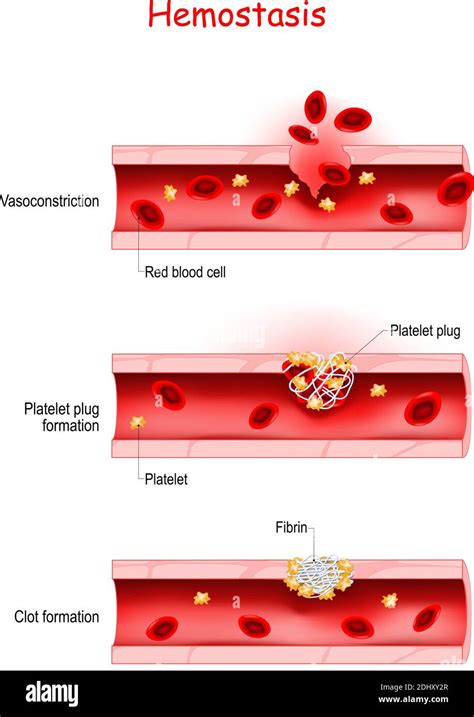 Hemostasis. Basic steps of wound healing process (Platelet plug ...