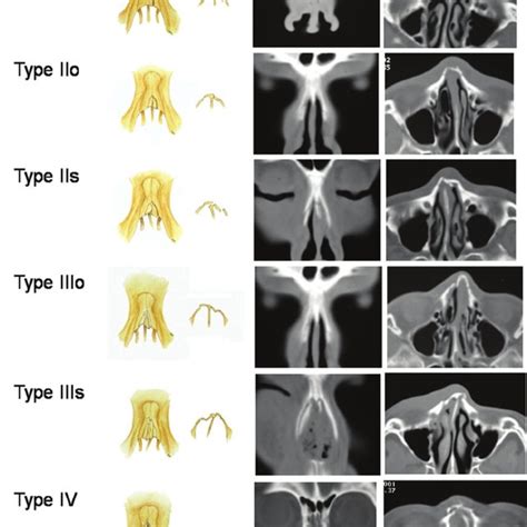 Classification of nasal bone fracture. | Download Scientific Diagram