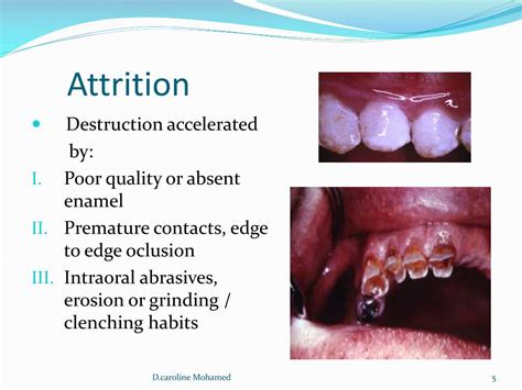 PPT - Tooth wear: aetiology , prevention, clinical implication PowerPoint Presentation - ID:2282917