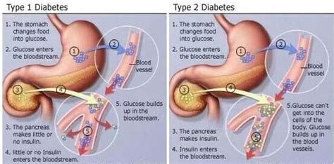 Type 1 vs Type 2 Diabetes-Difference Between Type 1 vs Type 2 Diabetes - Diabetes Suport