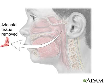 Ear, Nose, and Throat - Adenoid removal - series