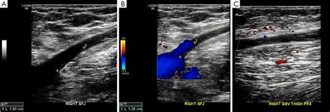 A short residual GSV stump (A,B) is frequently seen after endovenous... | Download Scientific ...