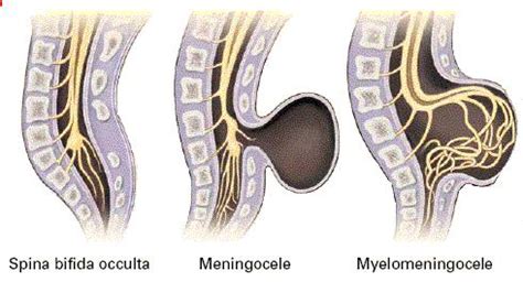 Spina bifida or Cleft Spine | Cerebral