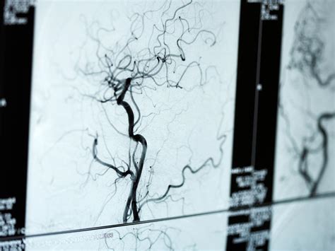 What is an angiogram? Uses, procedure, and results