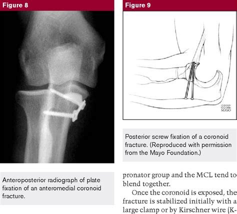 Figure 8 from Coronoid Process Fracture | Semantic Scholar