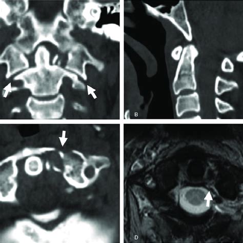 MRI of alar and transverse ligaments. High-resolution proton-weighted... | Download Scientific ...