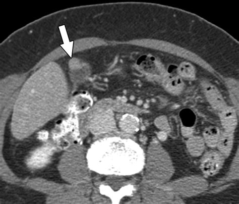 CT Differentiation of Adenomyomatosis and Gallbladder Cancer | AJR