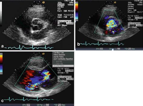 The Austin Flint Murmur | Thoracic Key