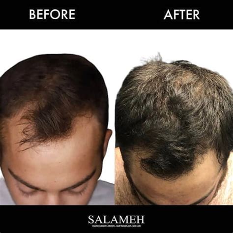 Hair Transplant Techniques: Then and Now - Salameh Plastic Surgery Center