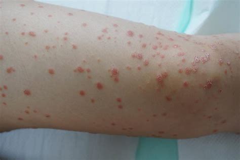 Psoriasis in Children: Types, Causes, Symptoms, And Treatment