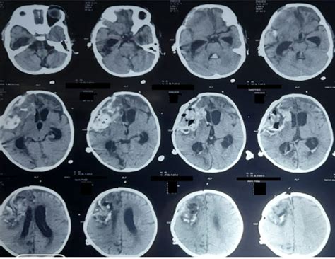 Post operative NCCT Head. | Download Scientific Diagram