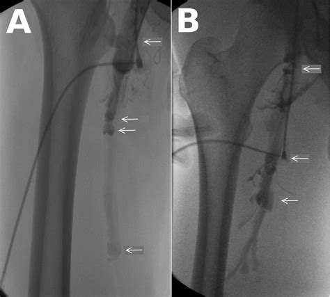 Resolution of DVT – JOSEF PFLUG VASCULAR LABORATORY