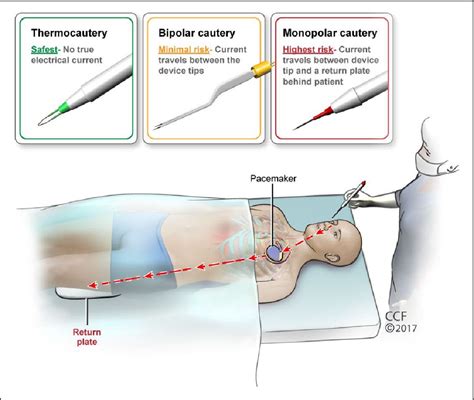 Cautery selection for oculofacial plastic surgery in patients with ...