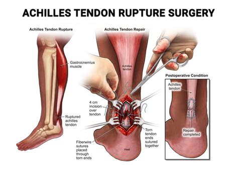 Achilles Tendon Rupture Surgery NJ | Achilles Tendon Tear Repair