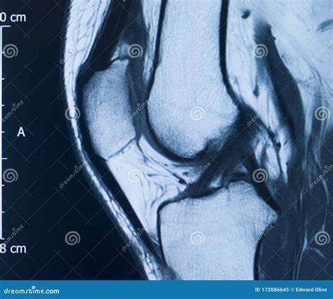 Knee injury mri mcl tear stock image. Image of fracture - 172886645