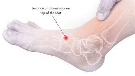 Bone Spur on top of foot: explained by a foot specialist