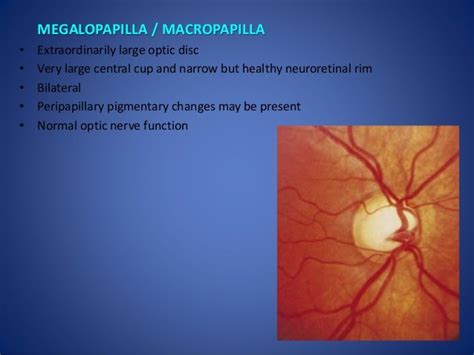 Optic disc evaluation