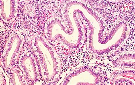 Secretory endometrium - Endometrium - MyPathologyReport.ca