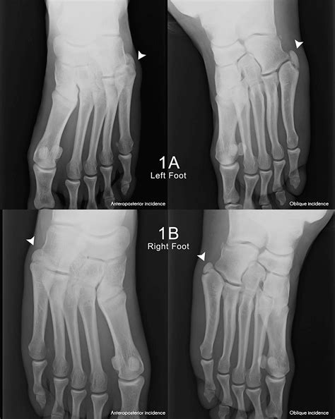 Knowing Your Accessory Foot Ossicles and Avoiding… – Hospinov-The platform for certified medical ...