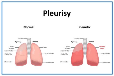 Pleurisy: Symptoms, Causes, Treatment, Diagnosis