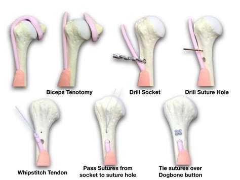 Biceps Tenodesis | St. George's Shoulder Unit